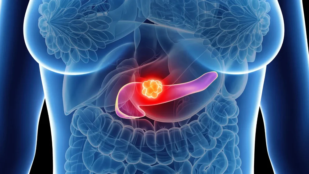 Entenda como a imunoterapia transforma o tratamento do câncer de pâncreas e conheça avanços como CAR-T. Leia agora.