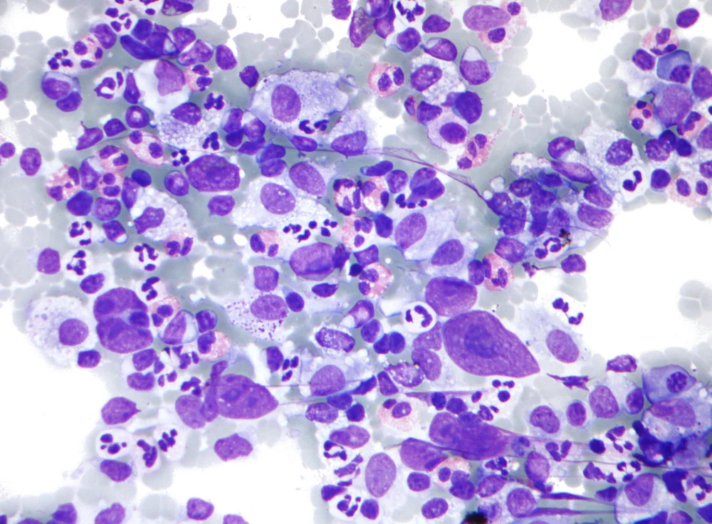 Descubra como a terapia celular transforma o tratamento do linfoma de Hodgkin e conheça avanços como CAR-T.